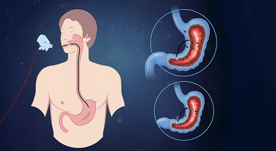 مخاطر عملية تكميم المعدة التي يجب أن تعرفها